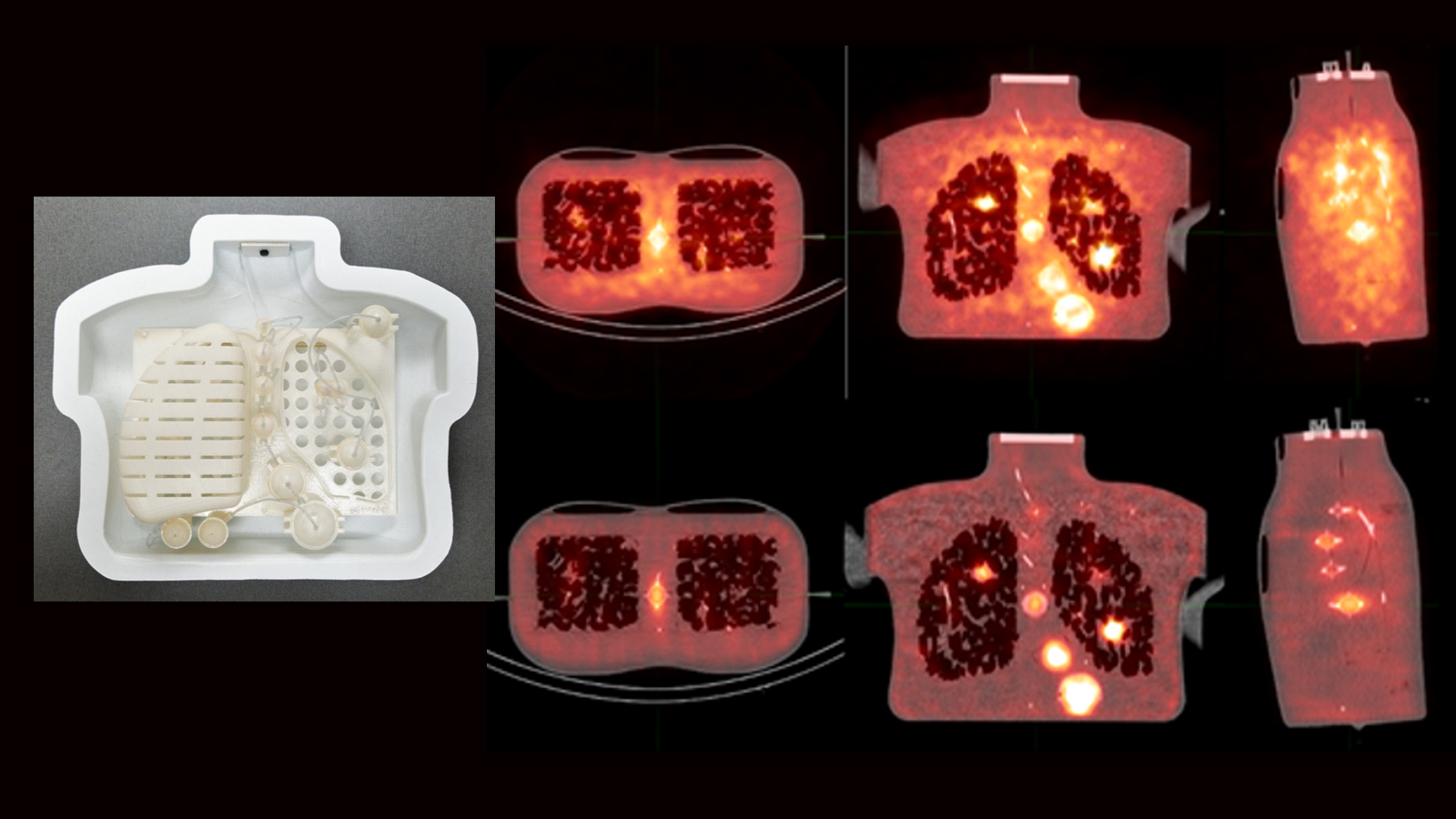 Scanned images of chest with radioisotopes used to diagnose cancer.